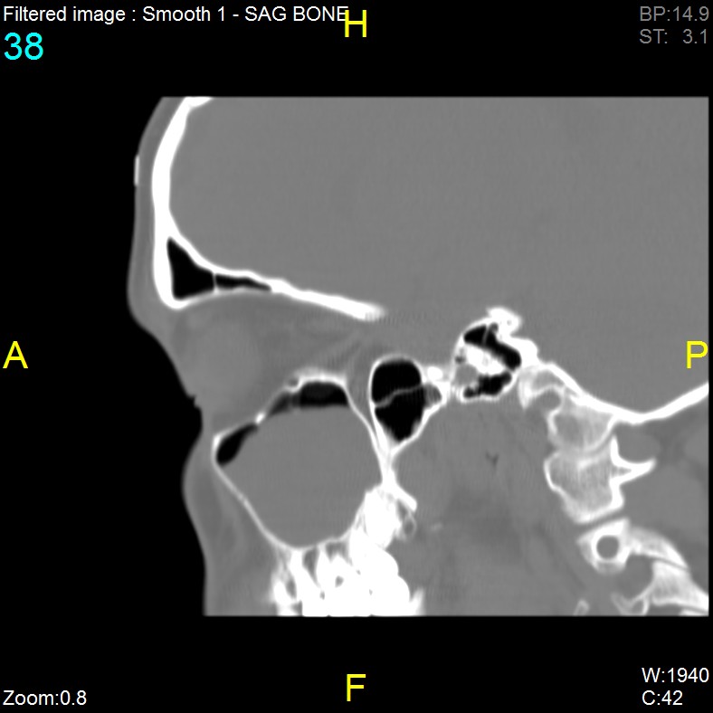 Antrochoanal polyp (Radiopaedia 65101-74094 Sagittal bone window 38).jpg