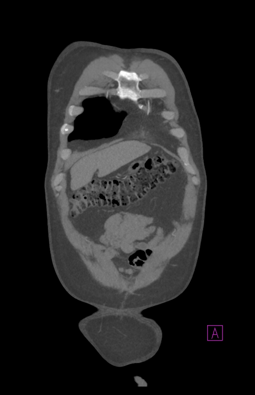 Aortectomy and axillary-bifemoral bypass (Radiopaedia 28303-28545 C 16).jpg