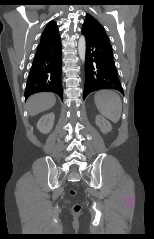 Aortectomy and axillary-bifemoral bypass (Radiopaedia 28303-28545 C 69).jpg