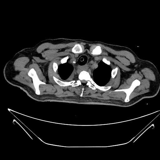 Aortic arch aneurysm (Radiopaedia 84109-99365 Axial non-contrast 40).jpg