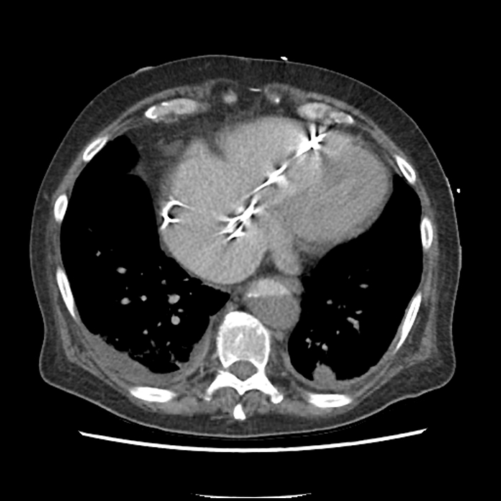Aortic arch graft infection (FDG PET-CT) (Radiopaedia 71975-82437 A 45).jpg