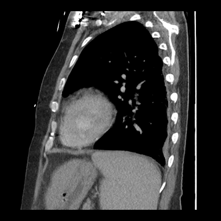 Aortic arch graft infection (FDG PET-CT) (Radiopaedia 71975-82437 C 51).jpg