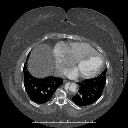 Aortic dissection- Stanford A (Radiopaedia 35729-37268 B 2).jpg
