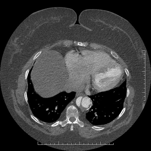 Aortic dissection- Stanford A (Radiopaedia 35729-37268 B 6).jpg