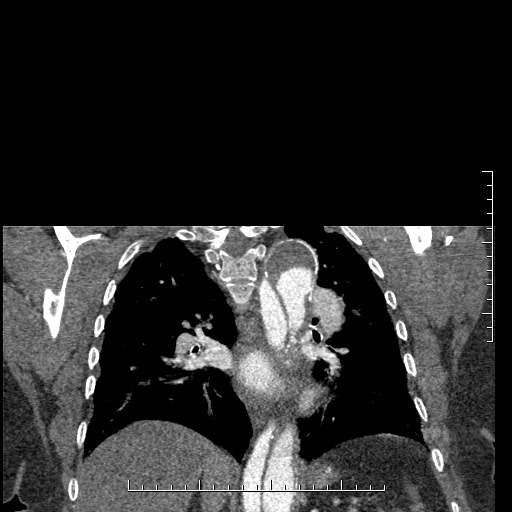 Aortic dissection- Stanford A (Radiopaedia 35729-37268 E 13).jpg