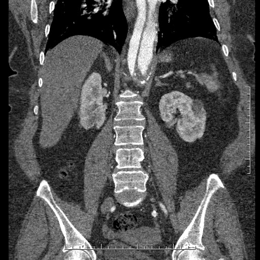 File:Aortic dissection- Stanford A (Radiopaedia 35729-37268 F 18).jpg