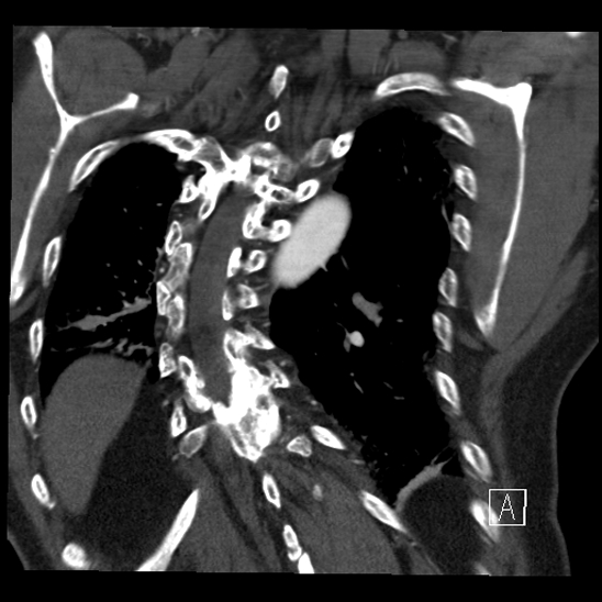 Aortic dissection (CTPA) (Radiopaedia 75506-86750 B 61).jpg