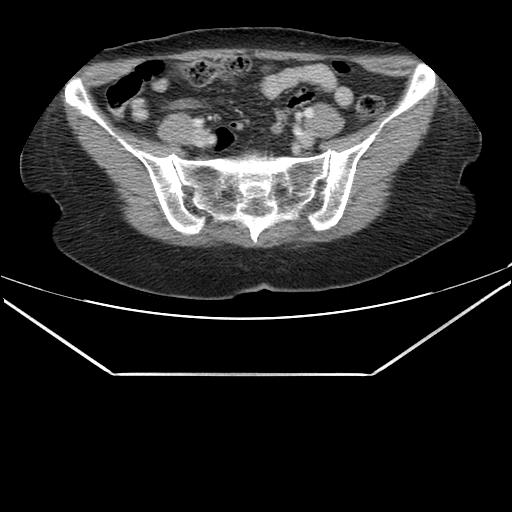 Aortic dissection (Radiopaedia 25350-25604 C 83).jpg
