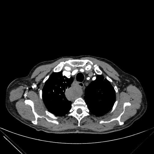 Aortic dissection (Radiopaedia 27466-27665 C+ arterial phase 7).jpg