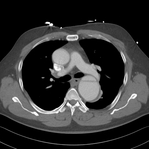 Aortic dissection (Radiopaedia 50763-56234 A 24).png