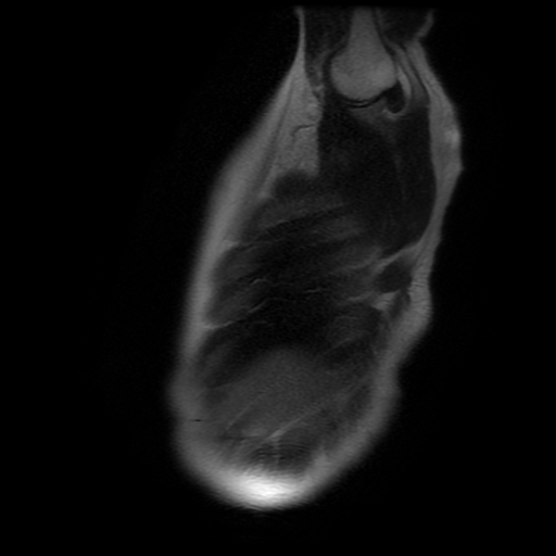 File:Aortic dissection - Stanford A -DeBakey I (Radiopaedia 28339-28586 Sagittal T2 26).jpg