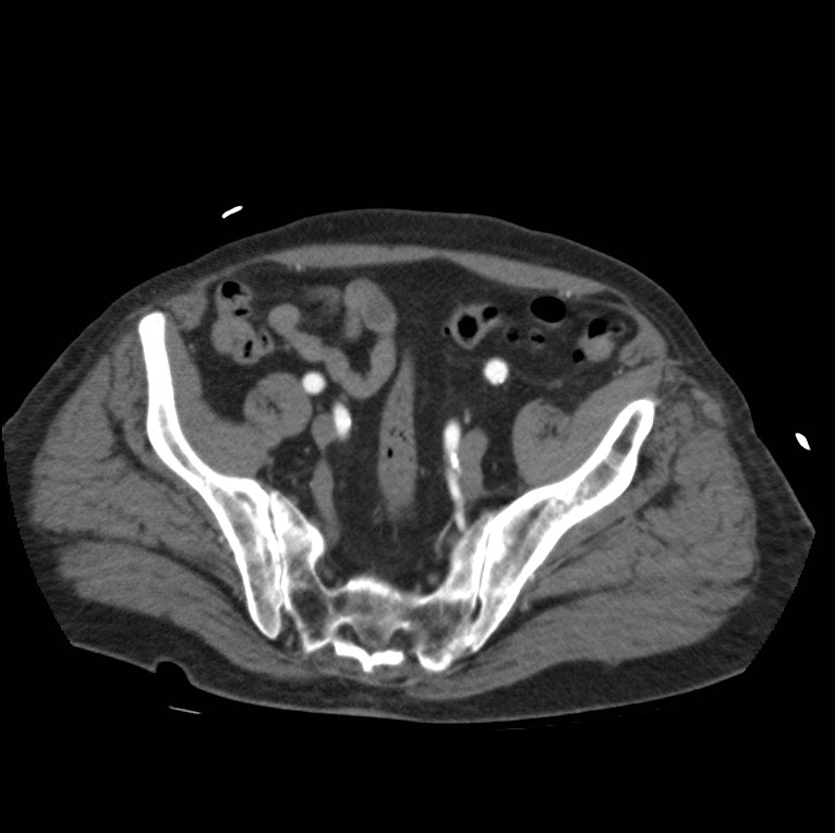 Aortic dissection with rupture into pericardium (Radiopaedia 12384-12647 A 79).jpg