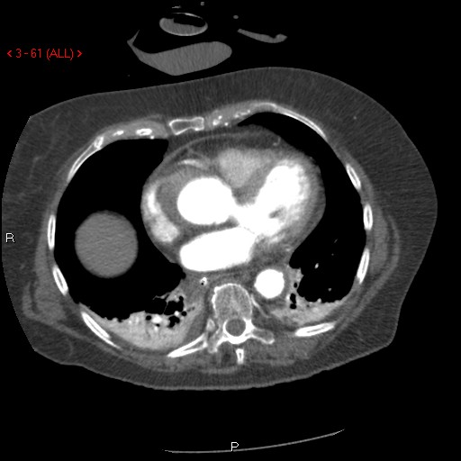 Aortic intramural hematoma (Radiopaedia 27746-28001 A 61).jpg