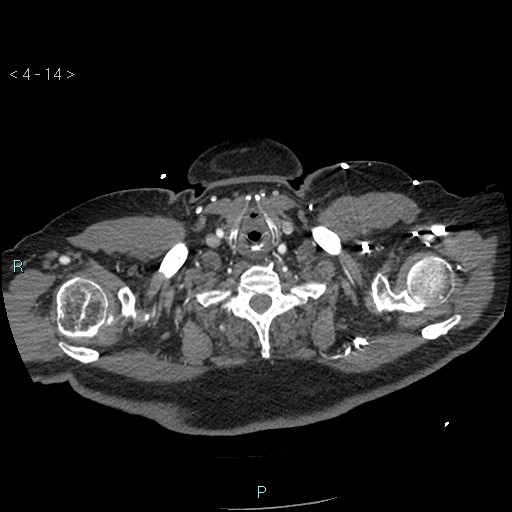 File:Aortic intramural hematoma (Radiopaedia 48463-53380 B 8).jpg