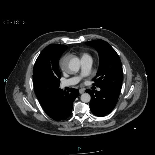Aortic intramural hematoma (Radiopaedia 48463-53380 C 81).jpg