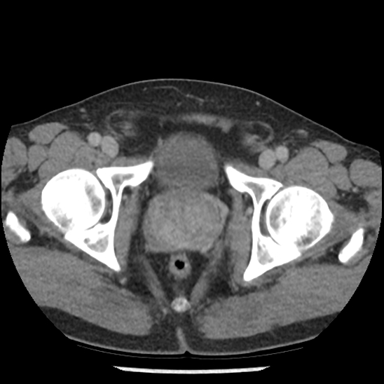Aortic intramural hematoma (type B) (Radiopaedia 79323-92387 Axial C+ delayed 112).jpg