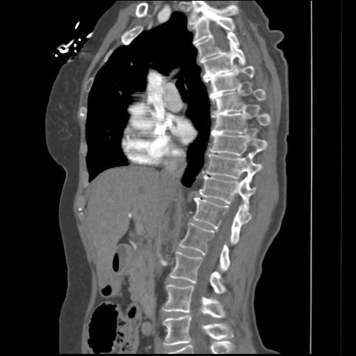 File:Aortic intramural hematoma from penetrating atherosclerotic ulcer (Radiopaedia 31137-31836 B 27).jpg