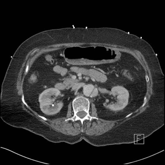 File:Aortic intramural hematoma with dissection and intramural blood pool (Radiopaedia 77373-89491 E 26).jpg