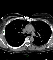 Aortic valve endocarditis (Radiopaedia 87209-103485 Axial non-contrast 41).jpg