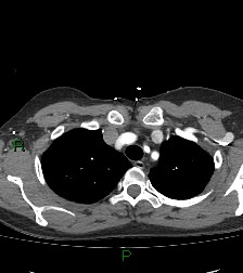 Aortic valve endocarditis (Radiopaedia 87209-103485 C 18).jpg