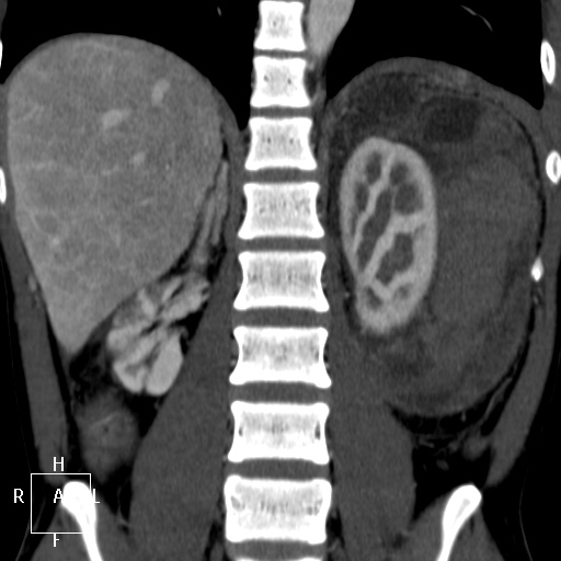 File:Aorto-left renal vein fistula (Radiopaedia 45534-49628 B 47).jpg