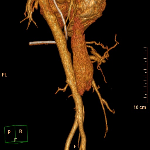 File:Aorto-left renal vein fistula (Radiopaedia 45534-49628 D 24).jpg