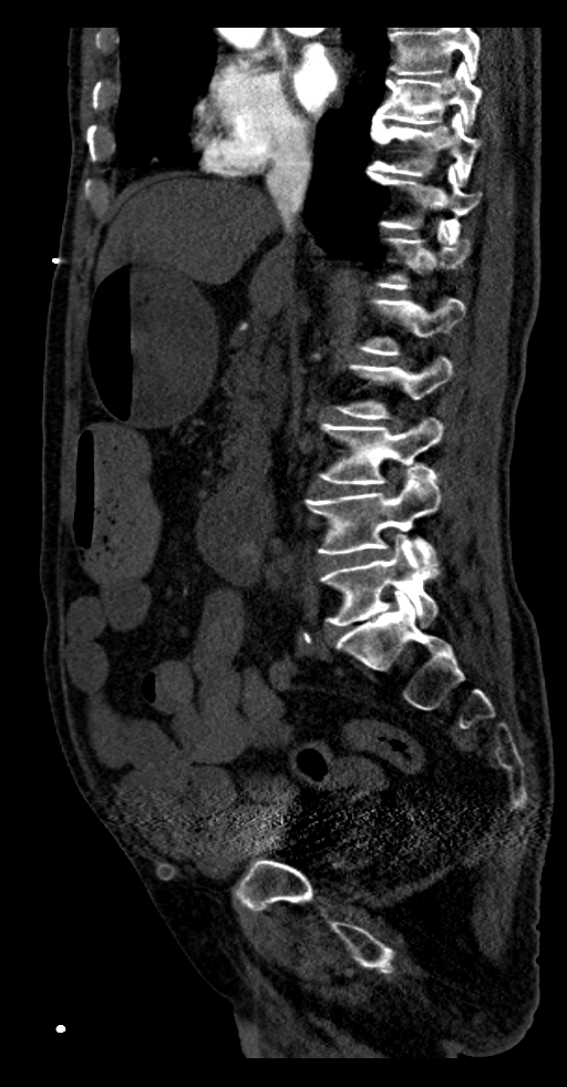 Aortoduodenal fistula (Radiopaedia 75286-86415 F 35).jpg