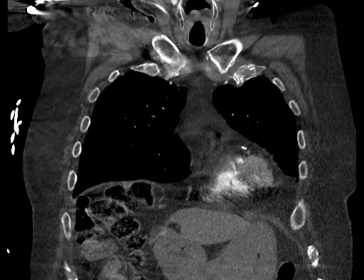 Aortoesophageal fistula with endovascular repair (Radiopaedia 73781-84592 Coronal C+ CTPA 27).jpg