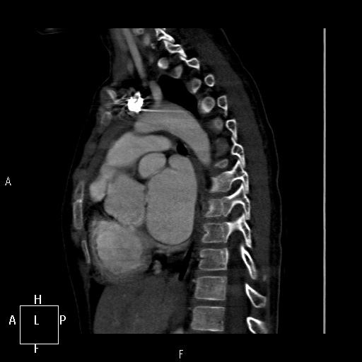 File:Aortopulmonary septal defect (Radiopaedia 41990-45013 Sagittal C+ CTPA 24).jpg