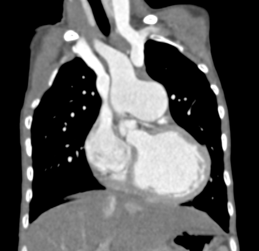 File:Aortopulmonary window, interrupted aortic arch and large PDA giving the descending aorta (Radiopaedia 35573-37074 D 25).jpg