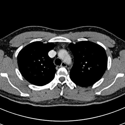 Apical lung mass mimic - neurogenic tumor (Radiopaedia 59918-67521 A 23).jpg