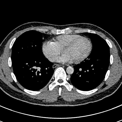 File:Apical lung mass mimic - neurogenic tumor (Radiopaedia 59918-67521 A 53).jpg
