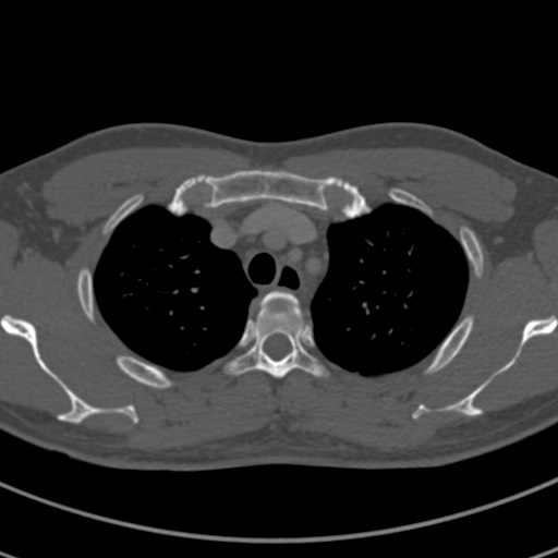 Apical lung mass mimic - neurogenic tumor (Radiopaedia 59918-67521 Axial bone window 18).jpg
