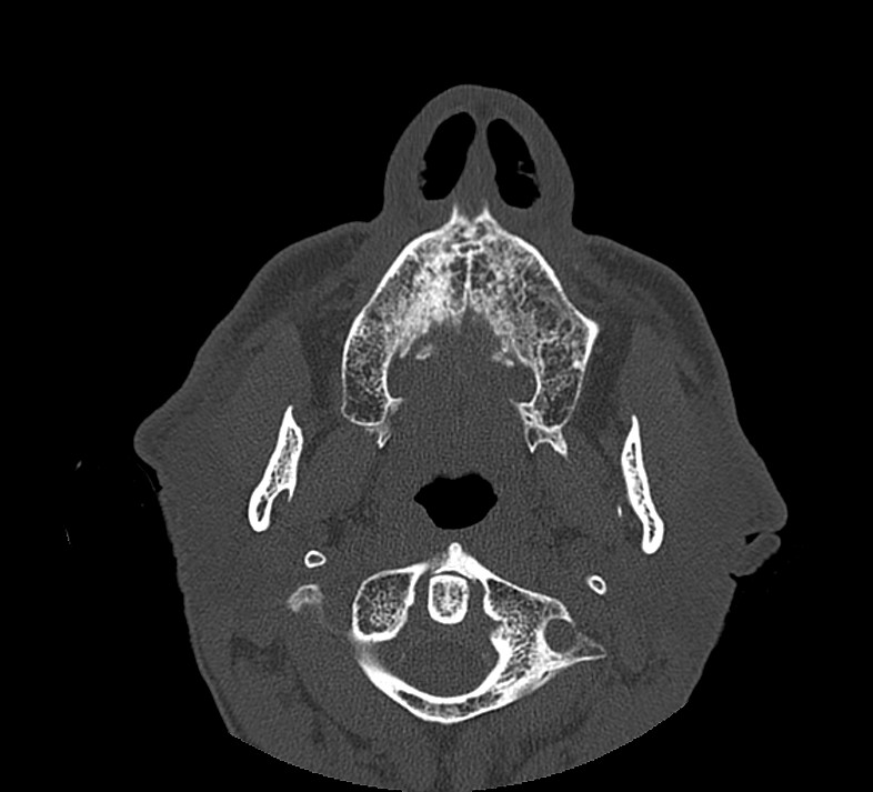 Aplastic maxillary sinuses (Radiopaedia 60030-67561 Axial non-contrast 11).jpg