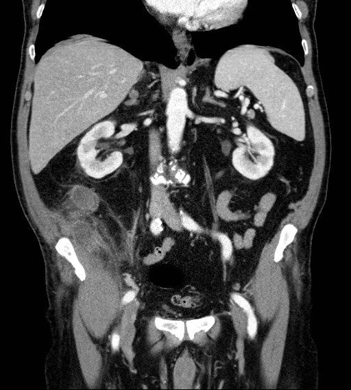 Appendiceal adenocarcinoma complicated by retroperitoneal abscess (Radiopaedia 58007-65039 A 44).jpg