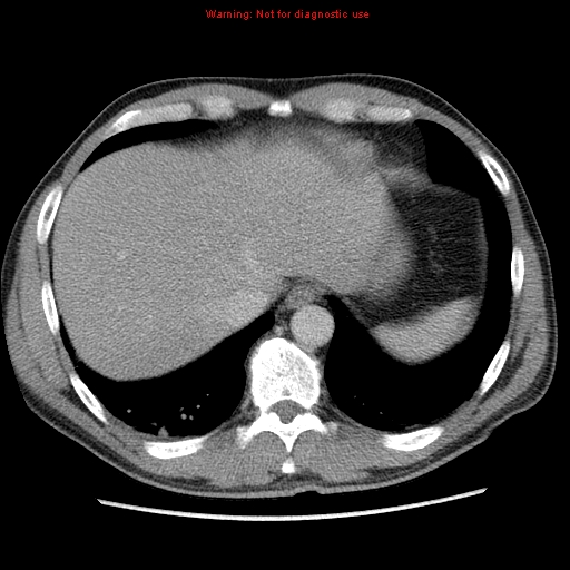 Appendicitis and renal cell carcinoma (Radiopaedia 17063-16760 A 6).jpg