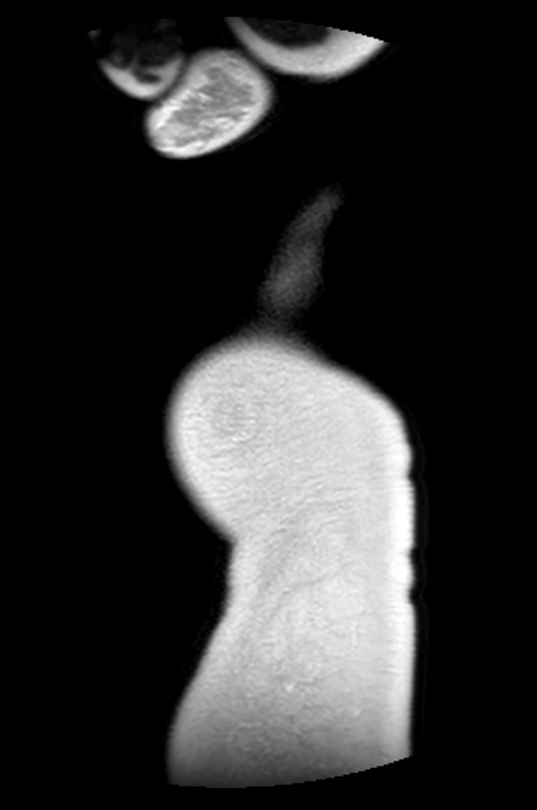 Appendicitis in gravida (MRI) (Radiopaedia 89433-106395 Sagittal T2 1).jpg