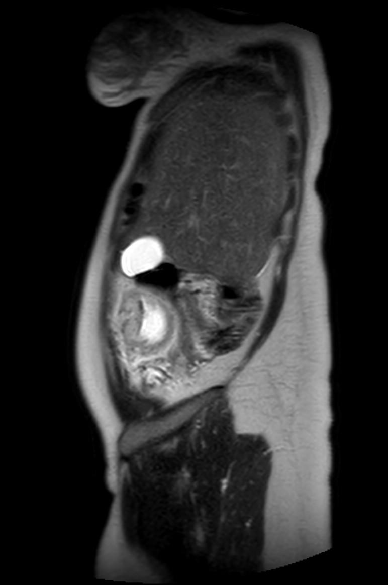 Appendicitis in gravida (MRI) (Radiopaedia 89433-106395 Sagittal T2 56).jpg