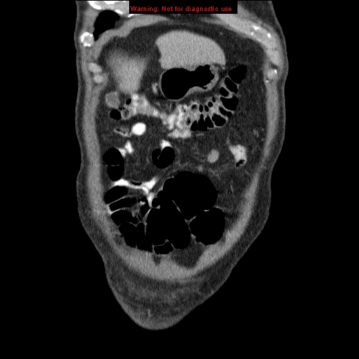 File:Appendicitis mass in inguinal hernia (Radiopaedia 26858-27029 B 6).jpg