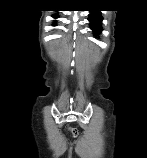 File:Appendicitis with localized perforation and abscess formation (Radiopaedia 49035-54130 B 46).jpg