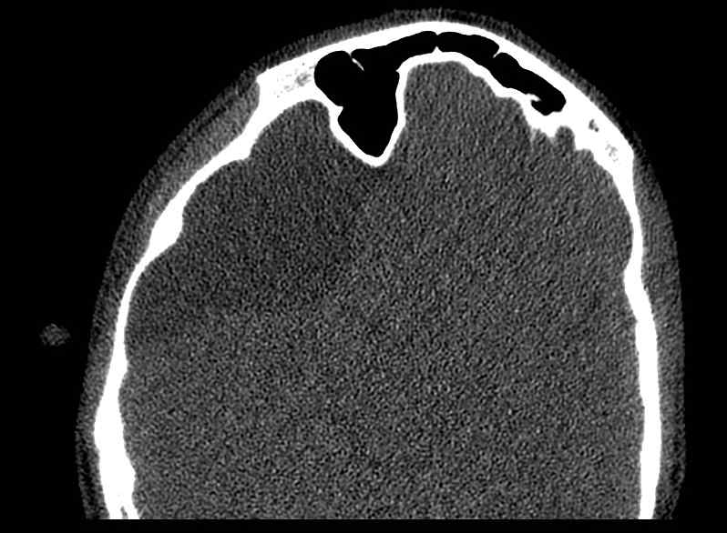 Arachnoid cyst- extremely large (Radiopaedia 68741-78450 Axial bone window 44).jpg