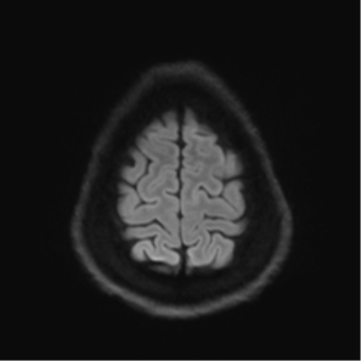 File:Arachnoid cyst - cerebellopontine angle (Radiopaedia 59689-67083 Axial DWI 68).png