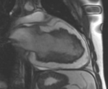 File:Arrhythmogenic right ventricular cardiomyopathy (Radiopaedia 69431-79307 2ch cine 13).jpg