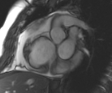 File:Arrhythmogenic right ventricular cardiomyopathy (Radiopaedia 69431-79307 Short axis cine 213).jpg