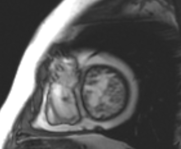 File:Arrhythmogenic right ventricular cardiomyopathy (Radiopaedia 69431-79307 Short axis cine 59).jpg