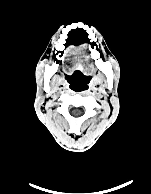 Arrow injury to the brain (Radiopaedia 72101-82607 Axial non-contrast 39).jpg