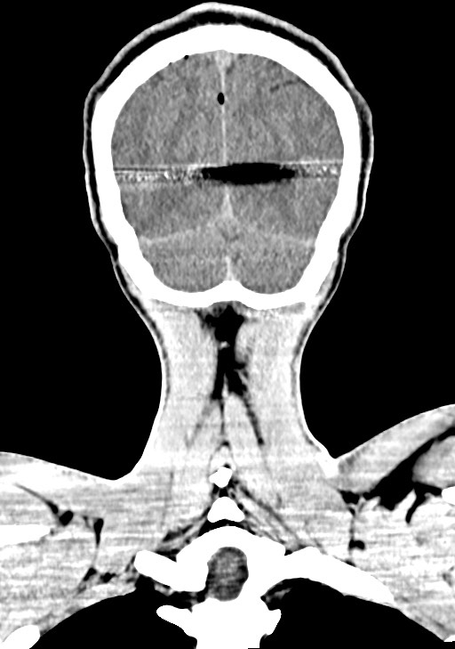 Arrow injury to the brain (Radiopaedia 72101-82607 Coronal non-contrast 61).jpg