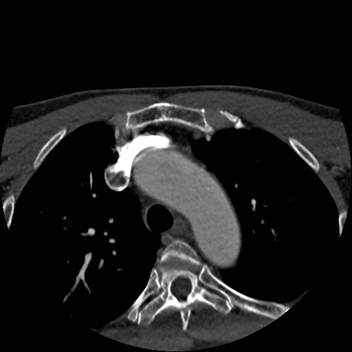 Artery of Percheron infarct (Radiopaedia 48088-52894 A 1).jpg