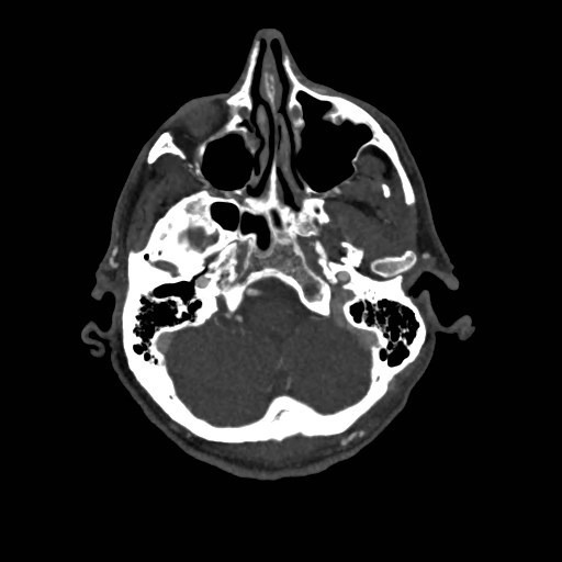 Artery of Percheron infarct (Radiopaedia 48088-52894 A 112).jpg