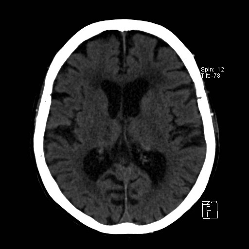 File:Artery of Percheron infarction (Radiopaedia 26307-26439 Axial non-contrast 24).jpg